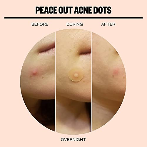 Peace Out Skincare Acne Healing Dots. 6-hours Fast Acting Anti-Acne Hydrocolloid Pimple Patches with Salicylic Acid to Clear Blemishes Overnight (20 dots)